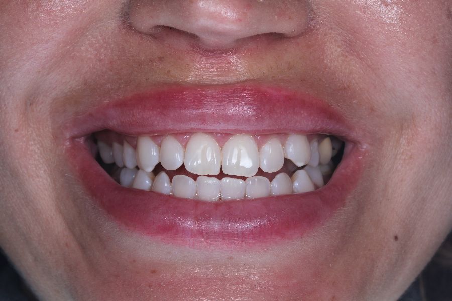 Фото работы Отбеливание с помощью аппарата Philips Zoom! WhyteSpeed (ZOOM4) 1