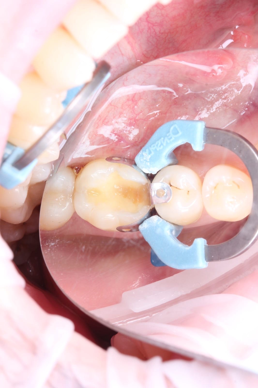 Фото работы Лечение скрытого кариеса 2